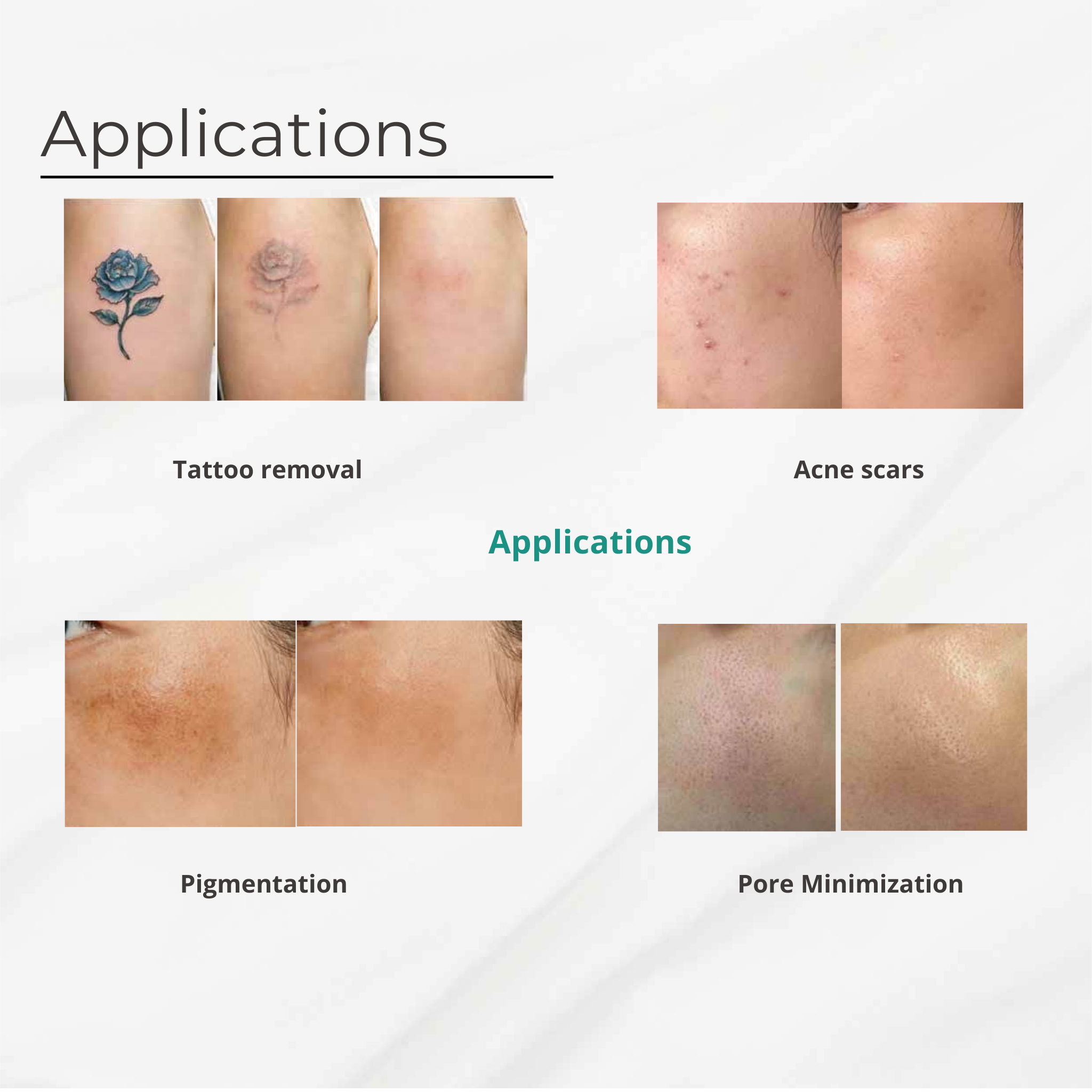 Q-Switched Nd:YAG Laser System for Tattoo Removal & Pigmentation Treatments VMS (Ventura Medtech Solutions) Online Store for Content and Products