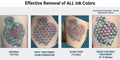 Non Laser PMU Removal an alternative to Lasers and users who cannot operate Lasers