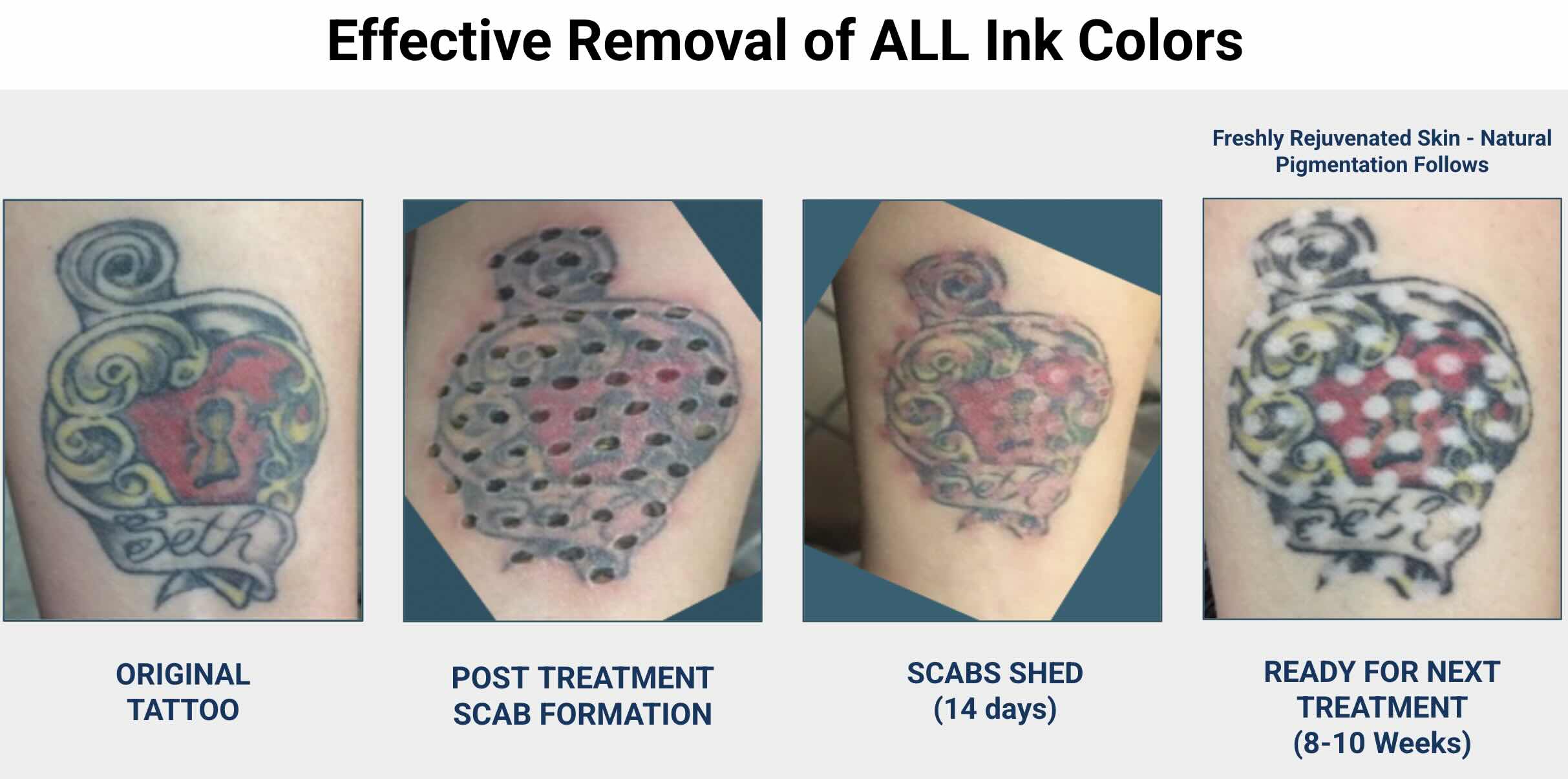Non Laser PMU Removal an alternative to Lasers and users who cannot operate Lasers