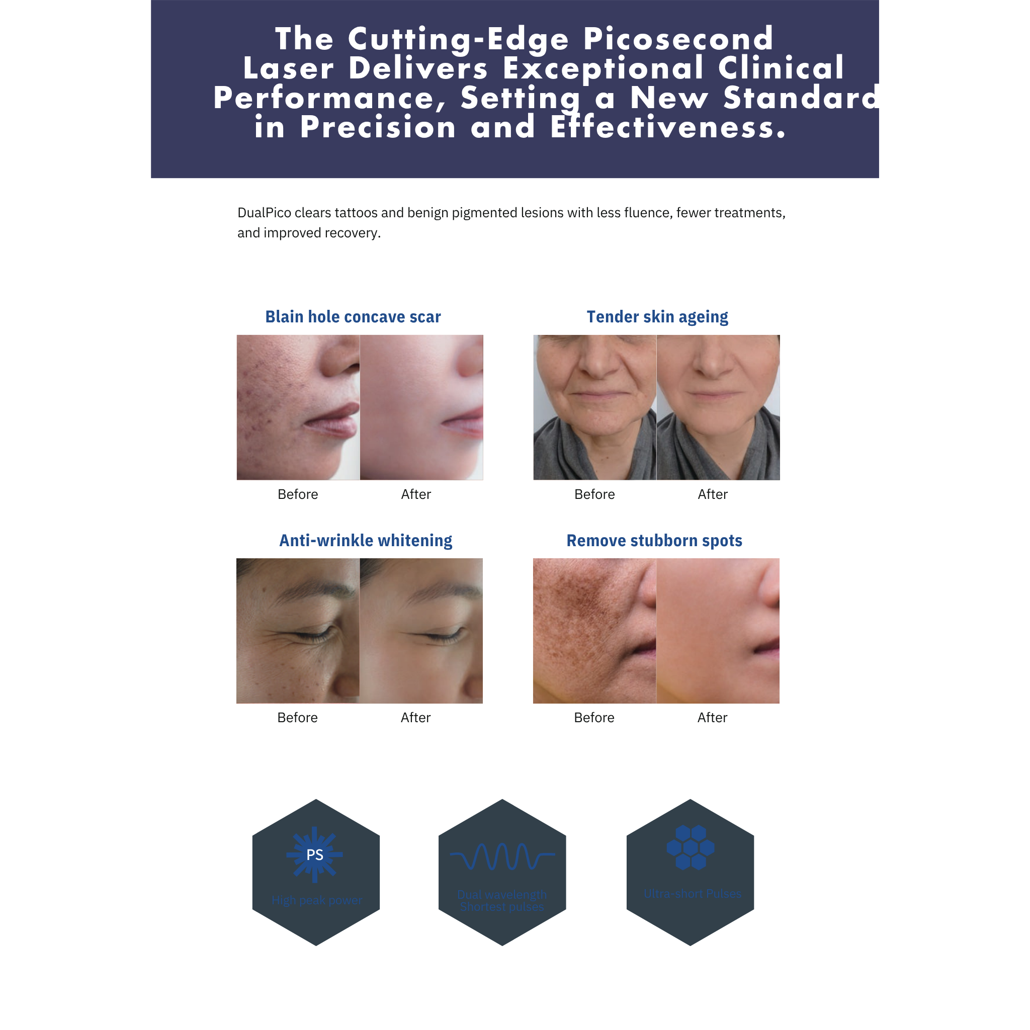 Game-changing Pico Second Laser for Tattoo Removal, Pigment Destruction and Skin Rejuvenation VMS (Ventura Medtech Solutions) Online Store for Content and Products