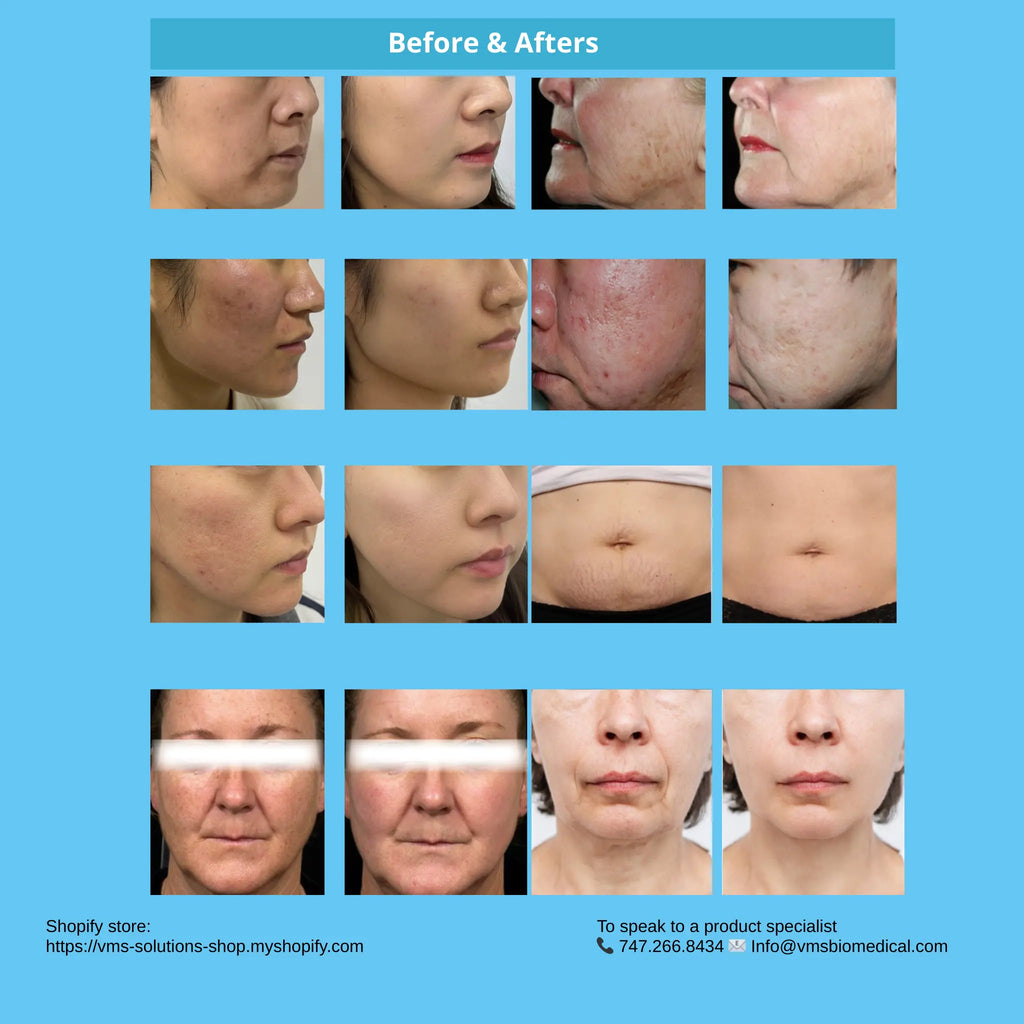 1927 nm Thulium Fiber laser for Precision Skin Rejuvenation with minimal downtime VMS SOLUTIONS SHOP