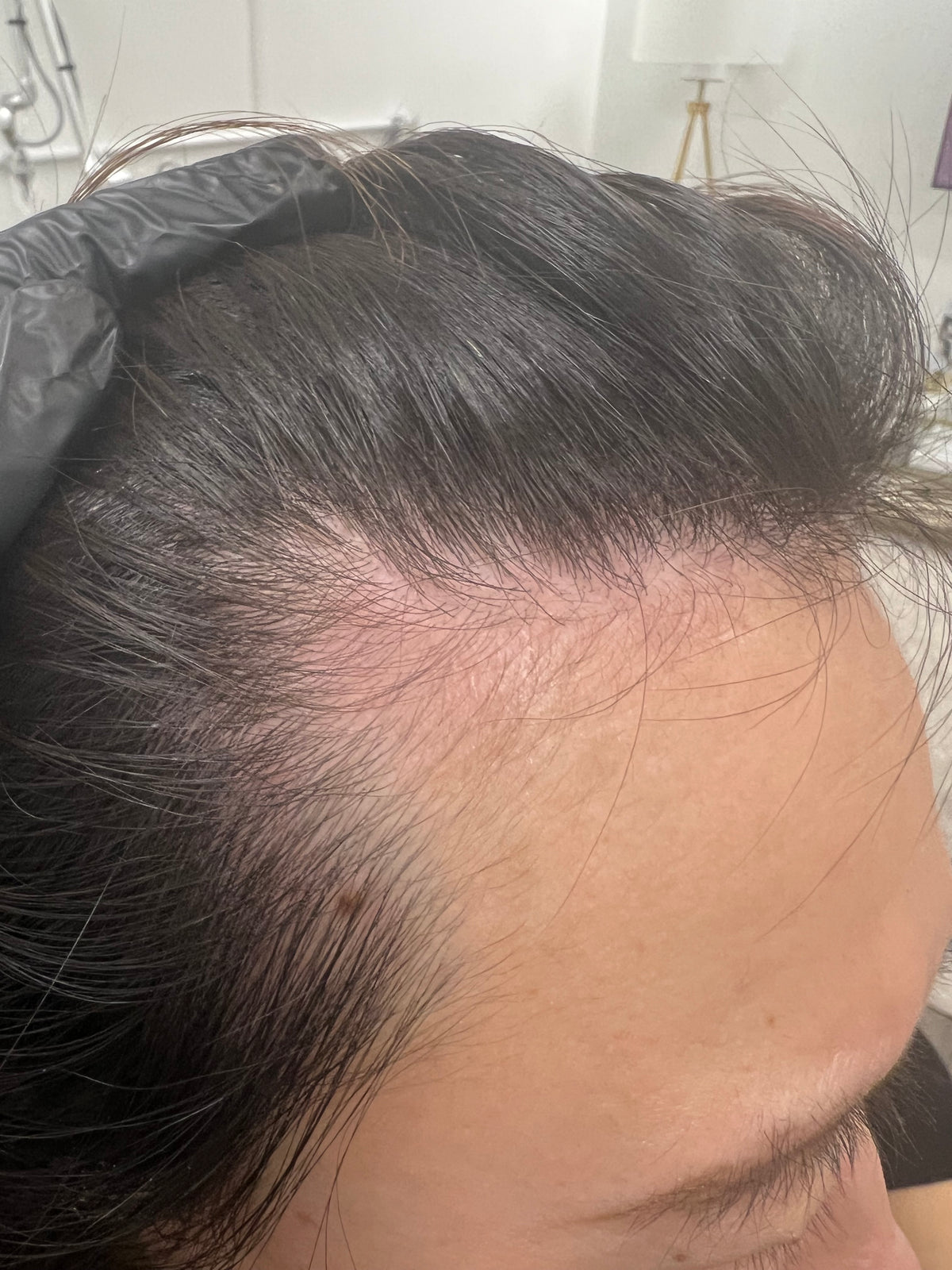 NOUVERE ERBIUM GLASS LASER FOR ADVANCED SKIN REJUVENATION and Hair Regrowth