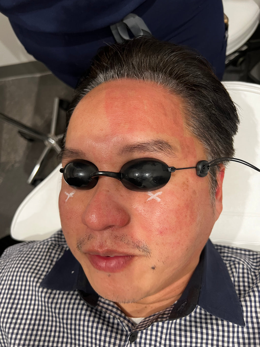 NOUVERE ERBIUM GLASS LASER FOR ADVANCED SKIN REJUVENATION and Hair Regrowth