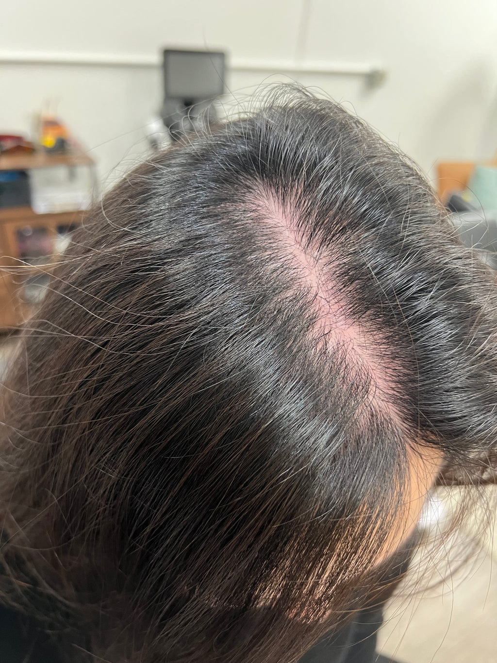 NOUVERE ERBIUM GLASS LASER FOR ADVANCED SKIN REJUVENATION and Hair Regrowth