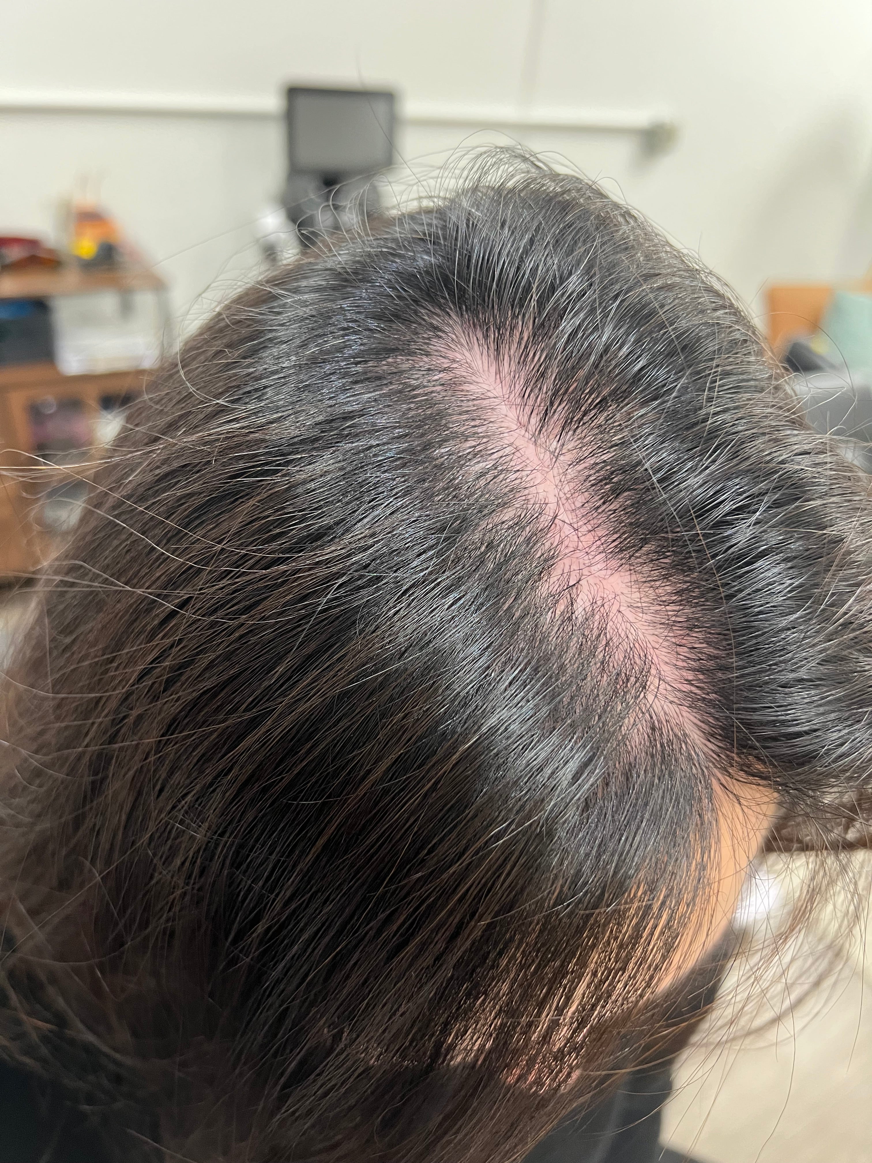NOUVERE ERBIUM GLASS LASER FOR ADVANCED SKIN REJUVENATION and Hair Regrowth
