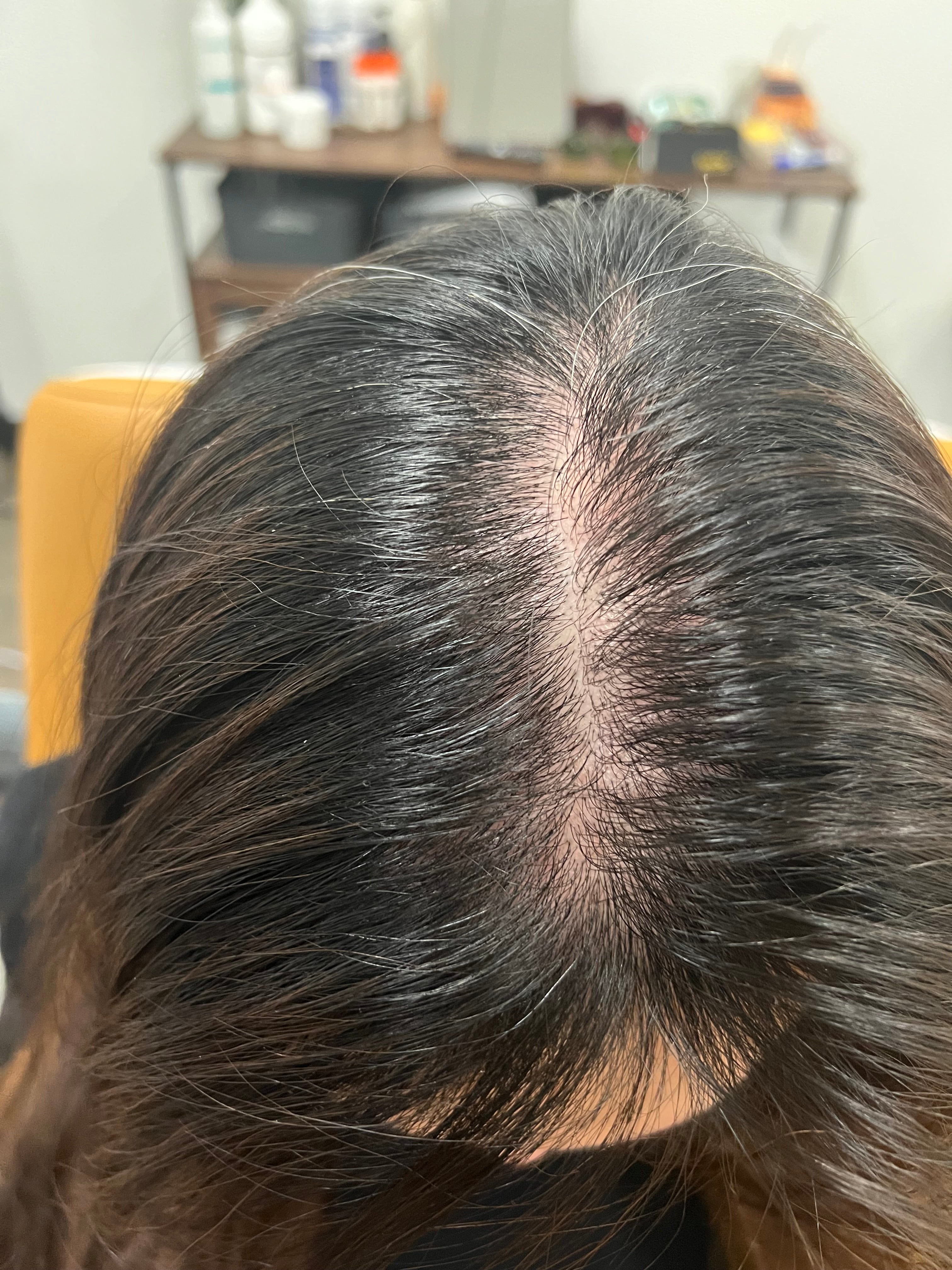 NOUVERE ERBIUM GLASS LASER FOR ADVANCED SKIN REJUVENATION and Hair Regrowth