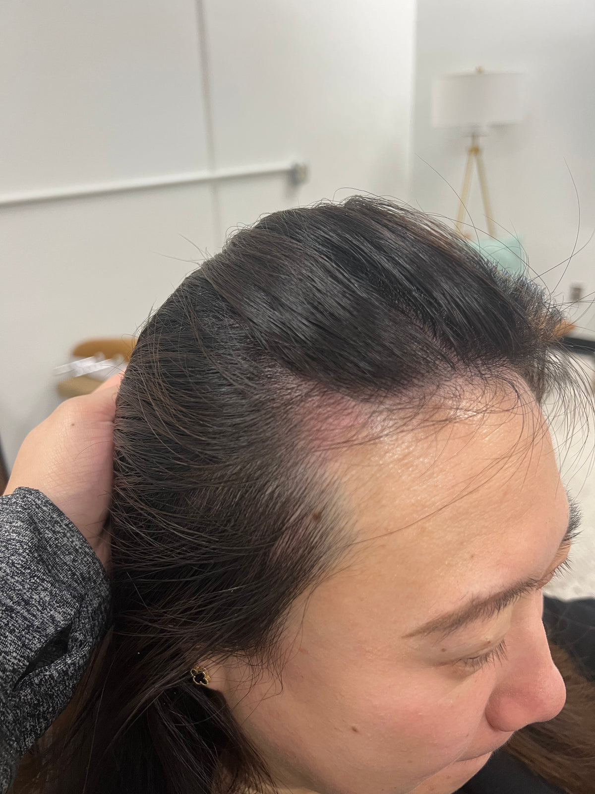 NOUVERE ERBIUM GLASS LASER FOR ADVANCED SKIN REJUVENATION and Hair Regrowth