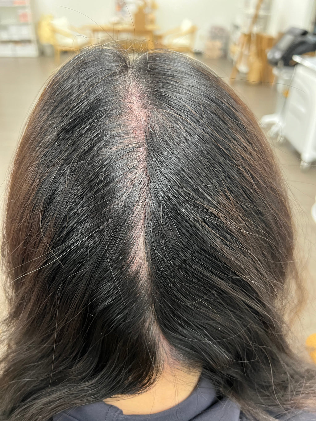 NOUVERE ERBIUM GLASS LASER FOR ADVANCED SKIN REJUVENATION and Hair Regrowth