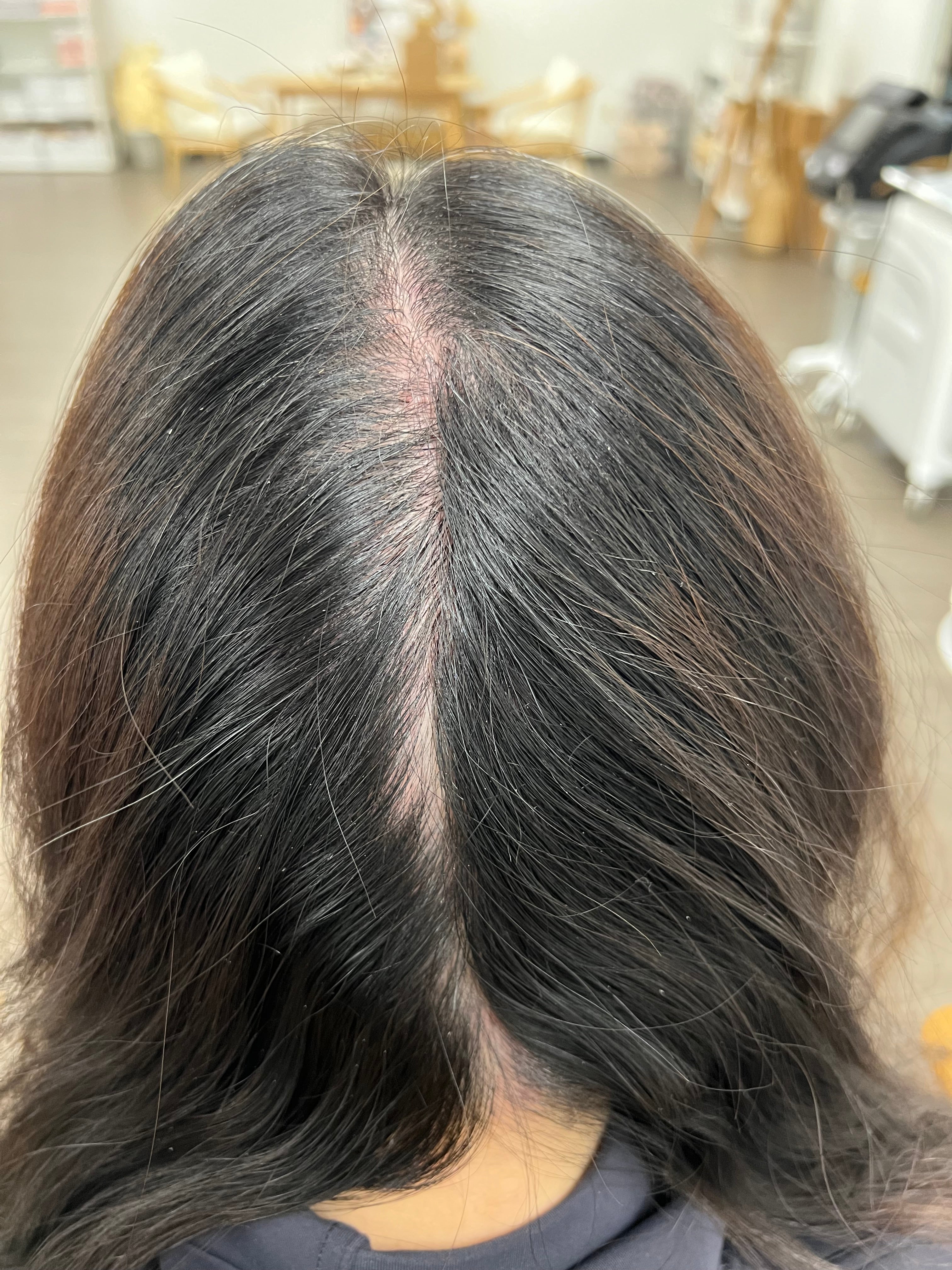 NOUVERE ERBIUM GLASS LASER FOR ADVANCED SKIN REJUVENATION and Hair Regrowth