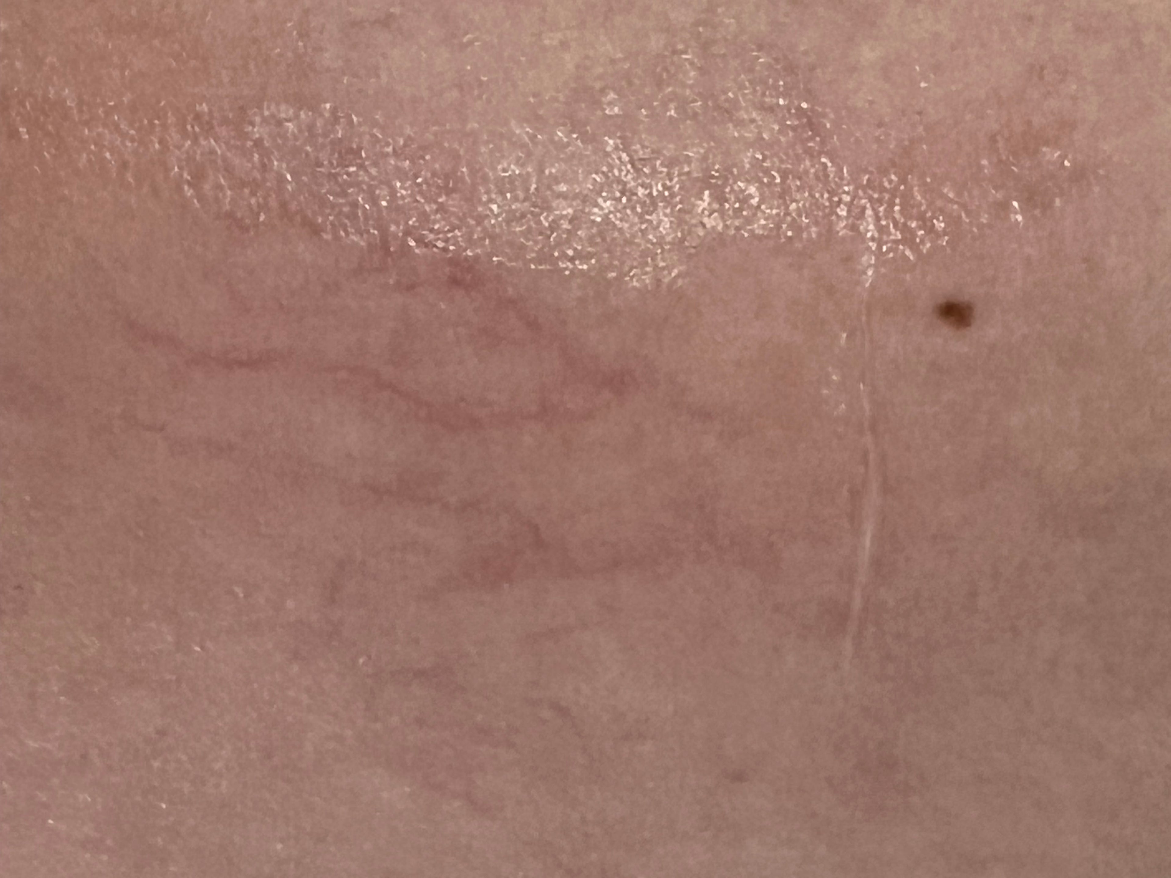 Impulx3™ IPL Machine | Lumecca & NBL Hero Alternative | OPT SHR for All Skin Types VMS (Ventura Medtech Solutions) Online Store for Content and Products
