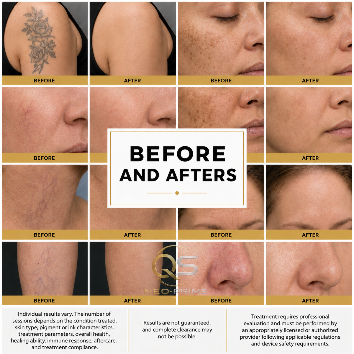 QS-Neo 350 ps Multi-Wavelength Picosecond Laser for Tattoo Removal &amp; Pigmentation AMAURY THE LASER KING TOP PICKS powered by VMS
