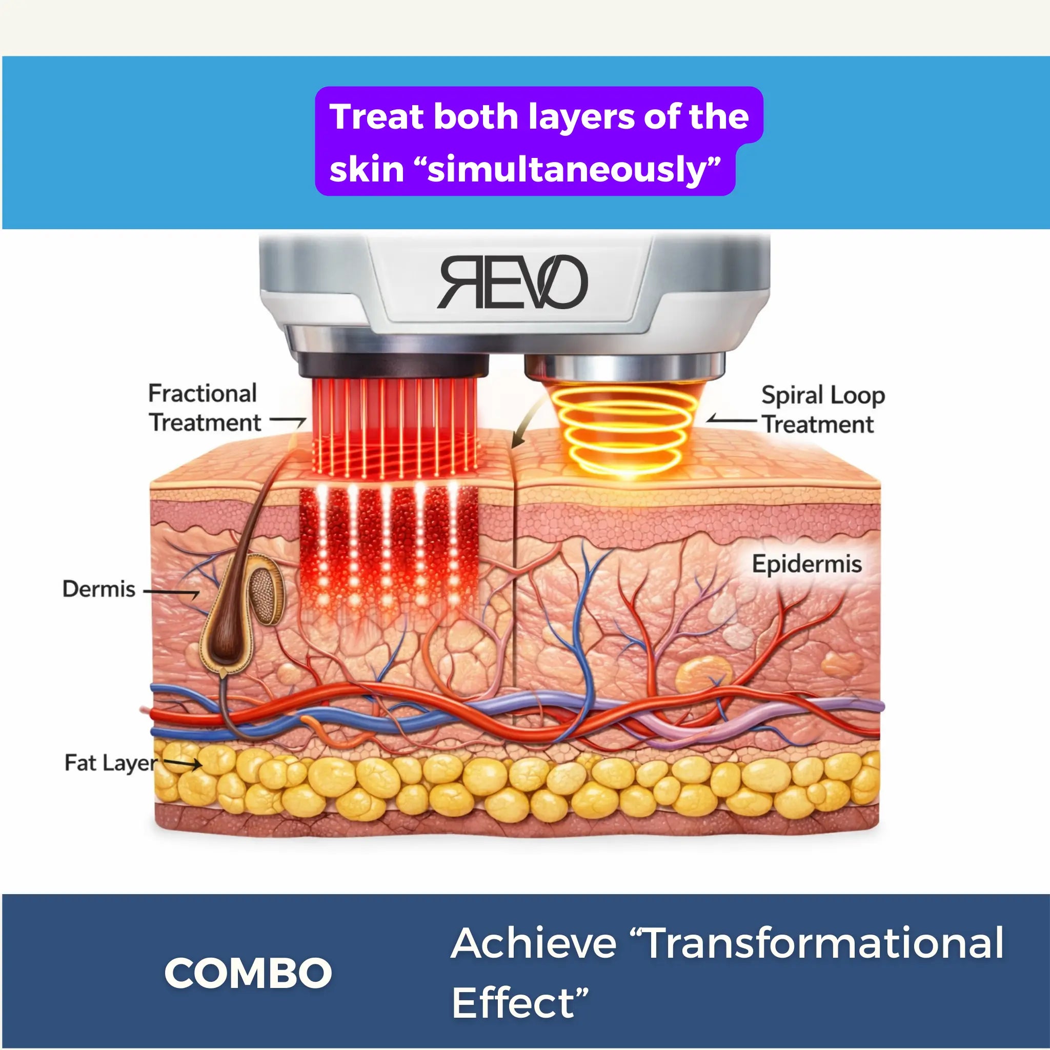 Revo CO₂ Laser | Fractional CO2 Skin Resurfacing System | designed for Surgeons and Aesthetic Providers VMS SOLUTIONS SHOP
