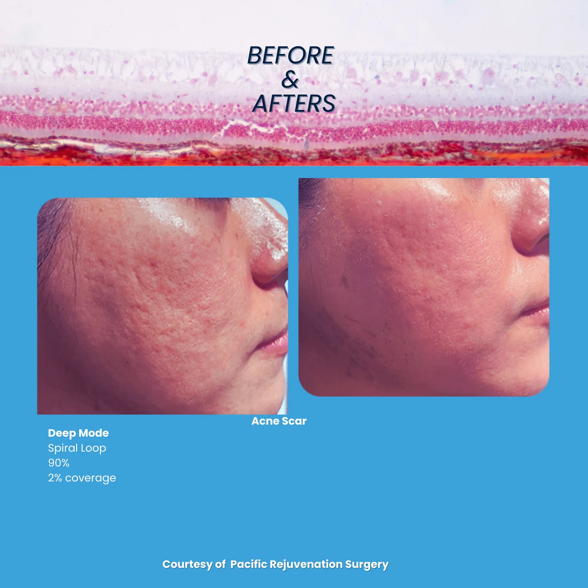 Revo CO₂ Laser | Fractional CO2 Skin Resurfacing System | designed for Surgeons and Aesthetic Providers VMS SOLUTIONS SHOP