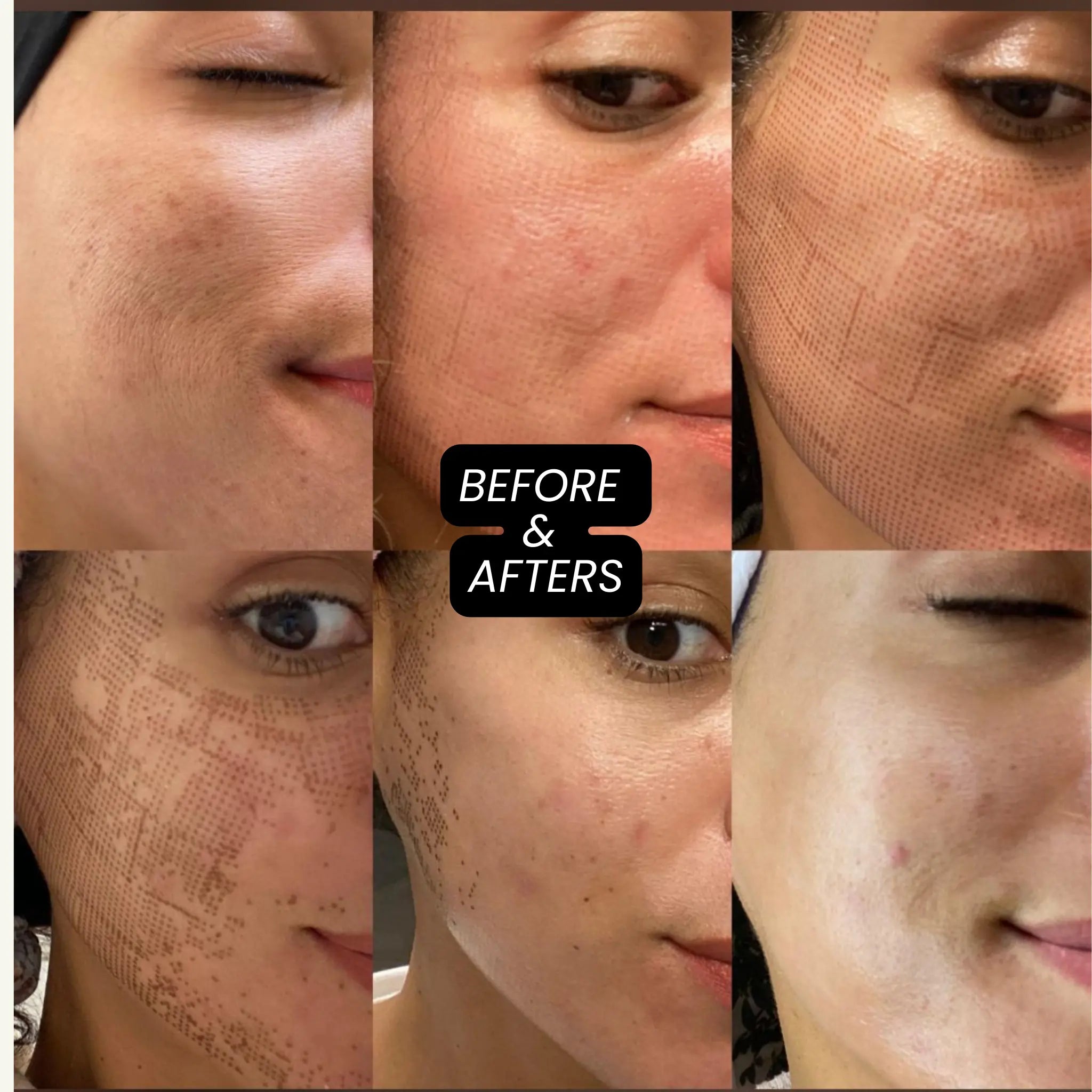 Revo CO₂ Laser | Fractional CO2 Skin Resurfacing System | designed for Surgeons and Aesthetic Providers VMS SOLUTIONS SHOP