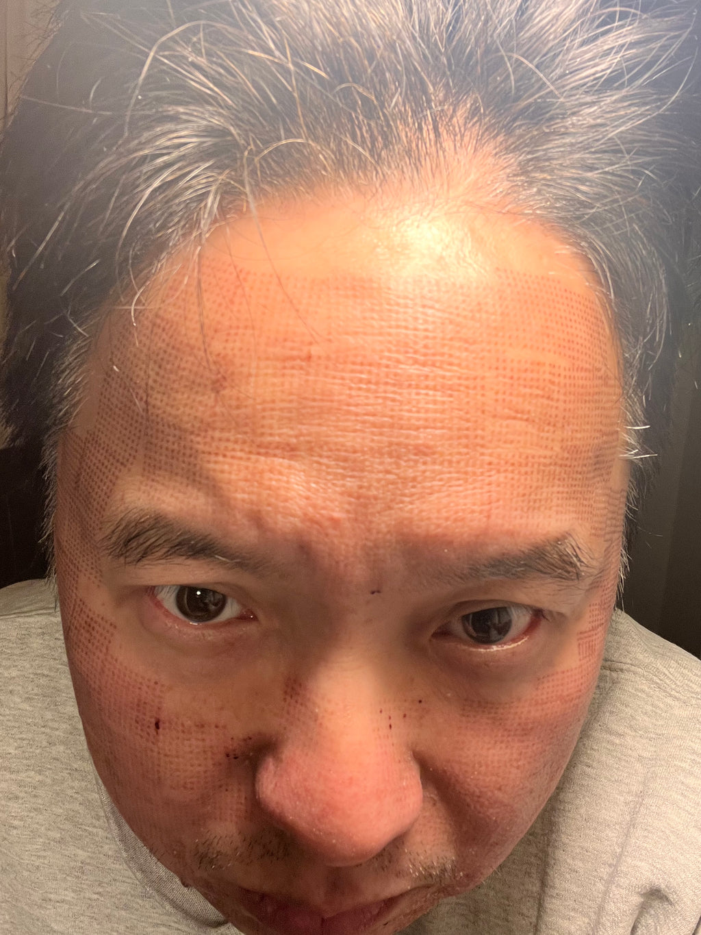 Revo C02 - Post Treatment Day 5 