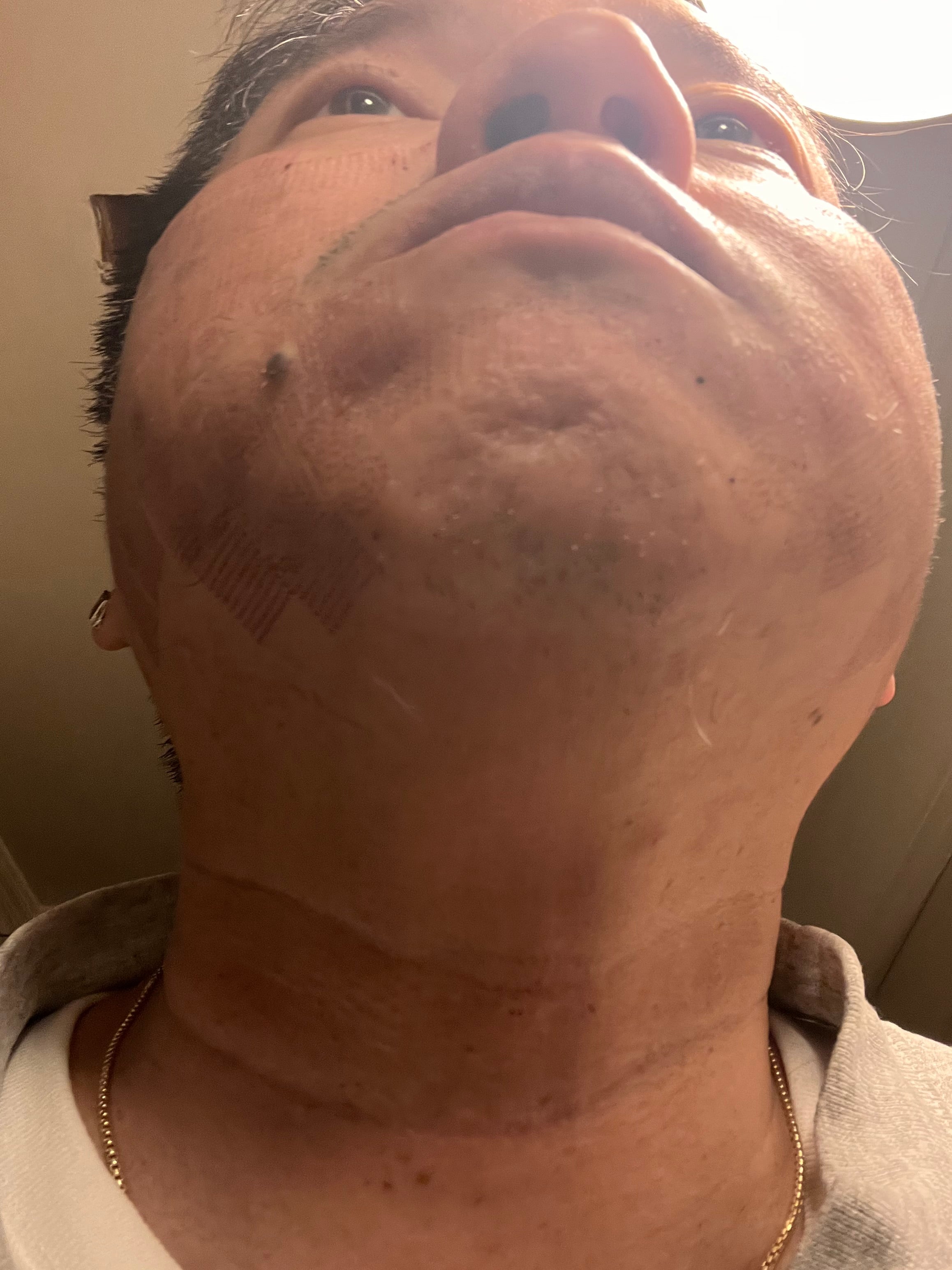 Revo C02 Laser Post Treatment - Day 5