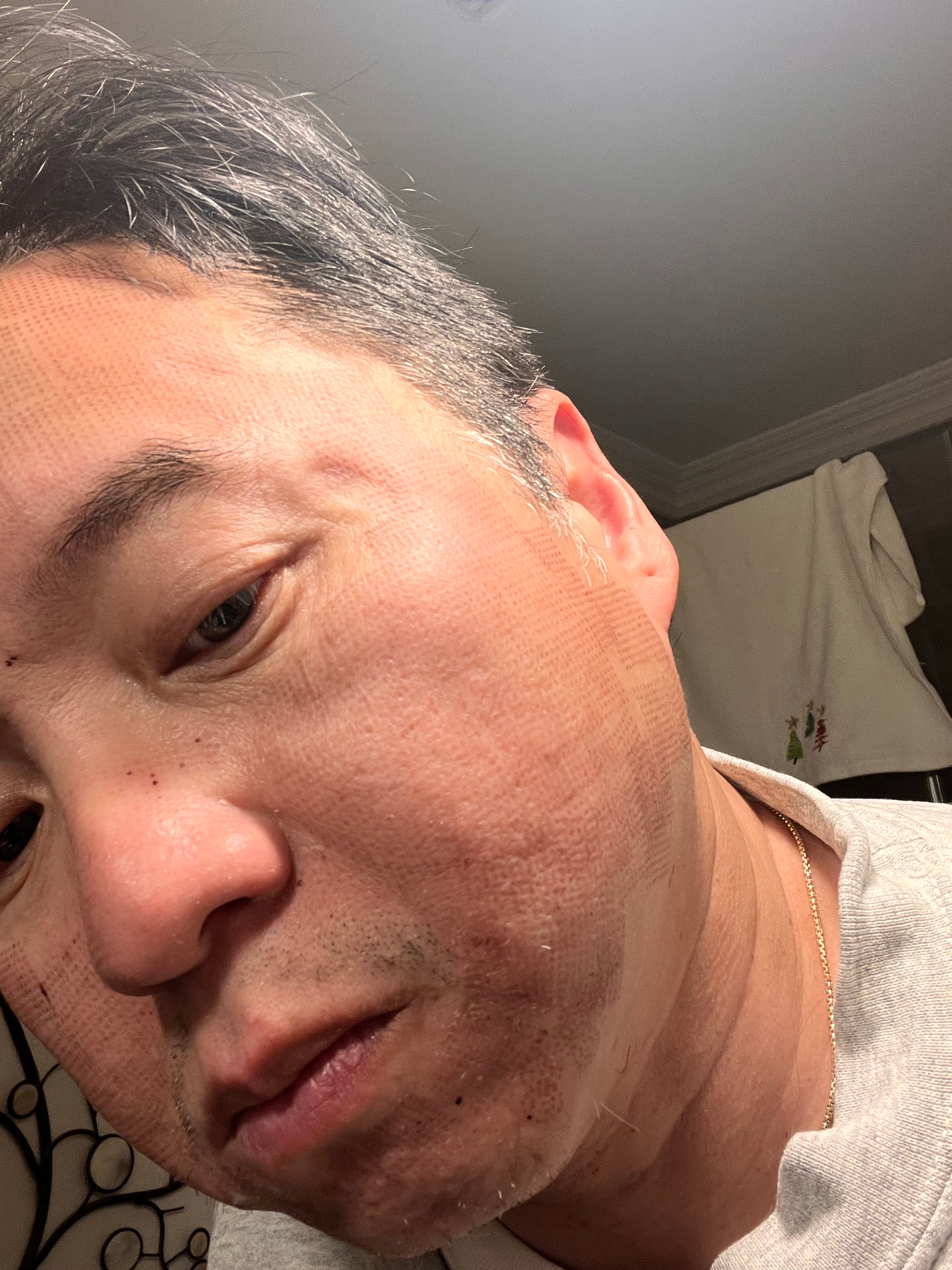 Revo C02 Post Treatment - Day 5 