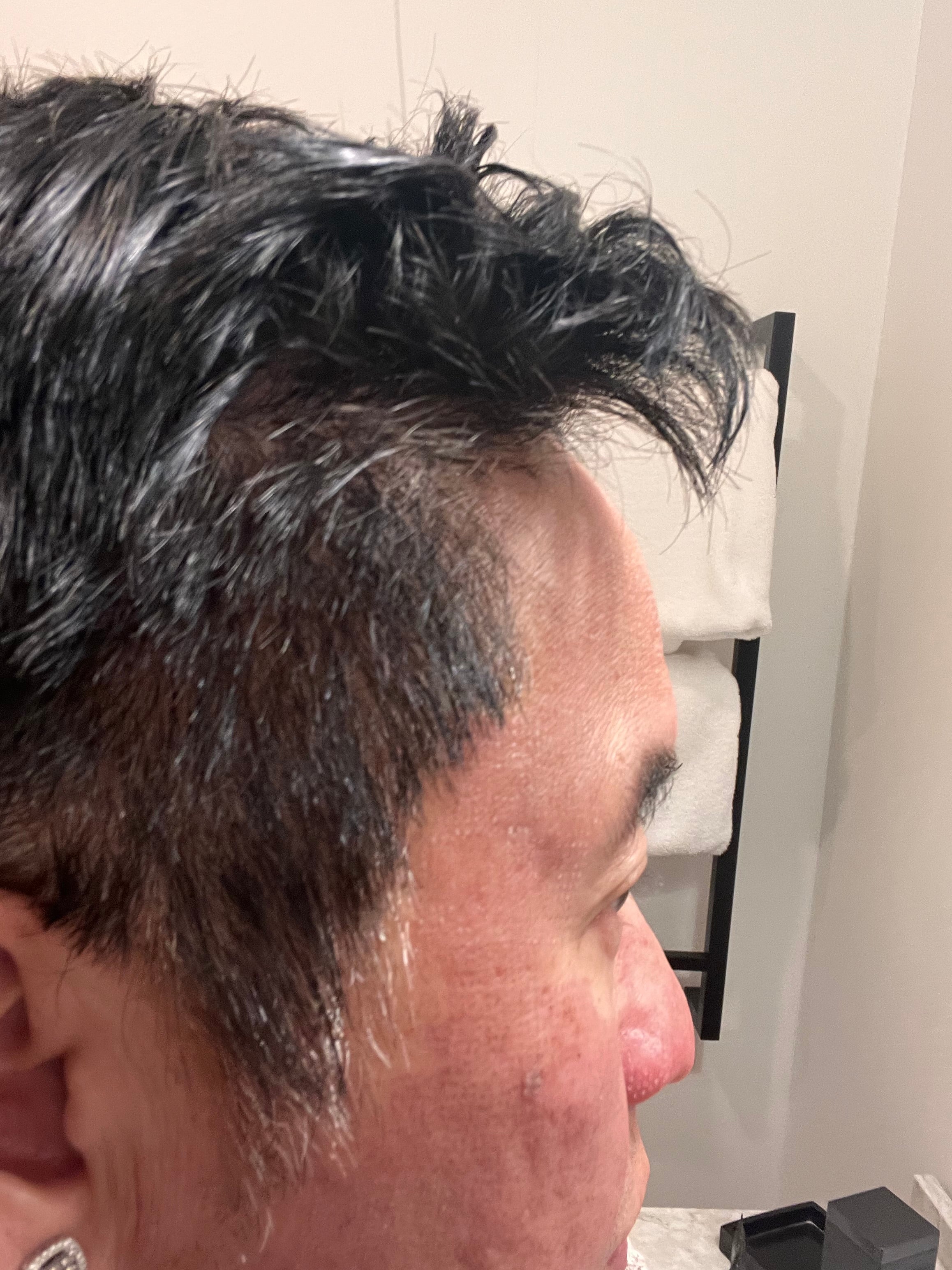 Revo C02 Left Cheek - Post Treatment