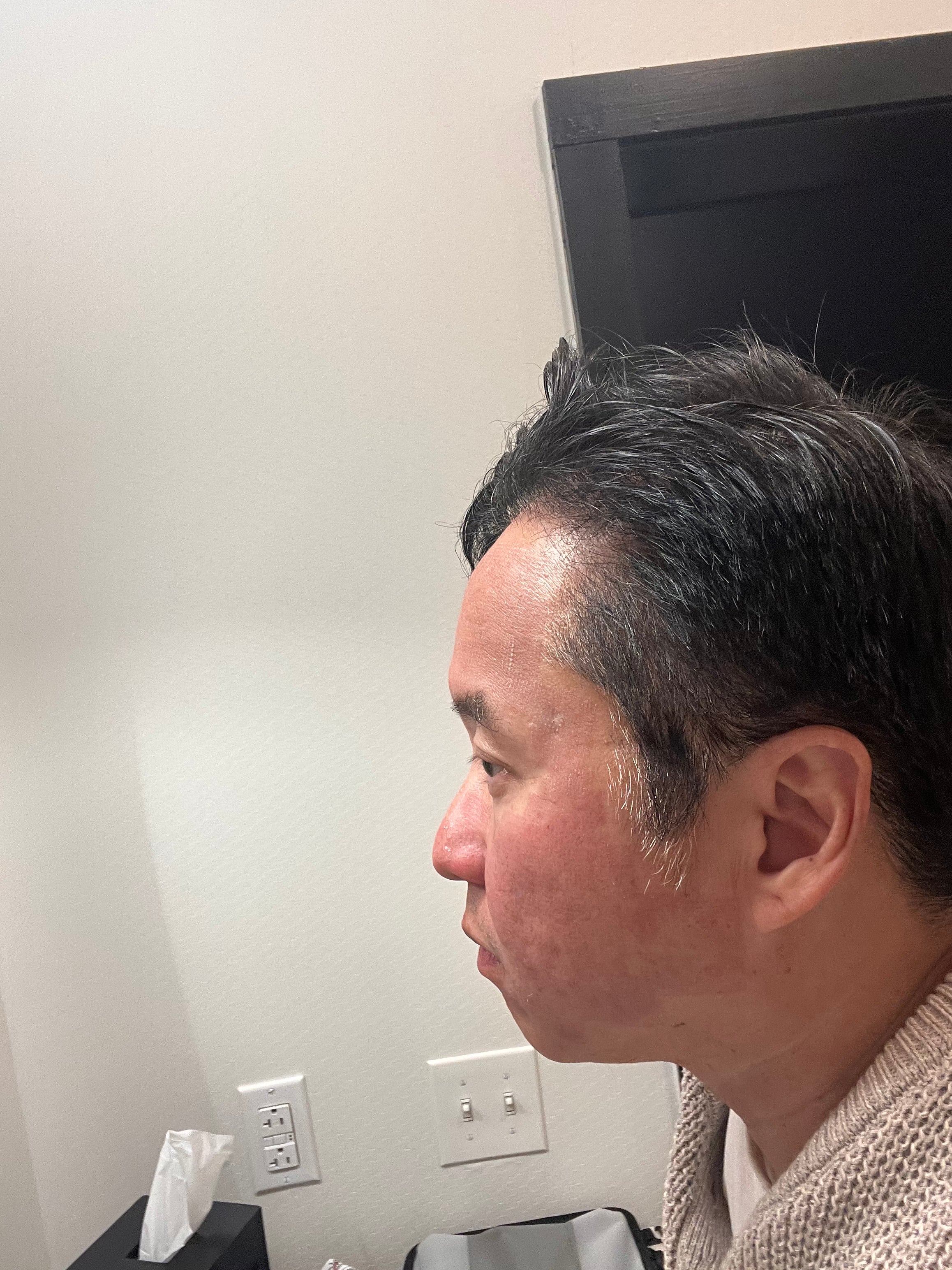 Day 2 after Revo C02 Treatment