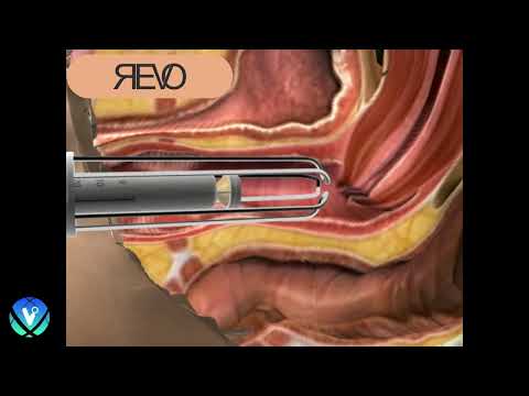 Revo CO₂ Laser | Fractional CO2 Skin Resurfacing System | designed for Surgeons and Aesthetic Providers